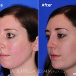Rhinoplasty2016164