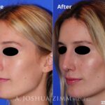 Rhinoplasty2016166