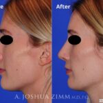 Rhinoplasty2016167