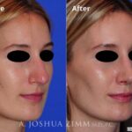 Rhinoplasty2016168