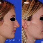 Rhinoplasty2016169