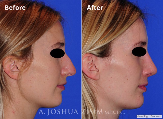 Rhinoplasty2016169