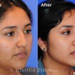 Rhinoplasty201617