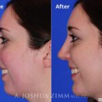 Rhinoplasty2016170