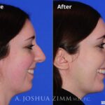 Rhinoplasty2016171