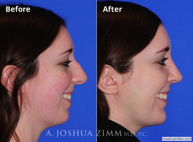 Rhinoplasty2016171