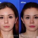 Rhinoplasty2016172 1