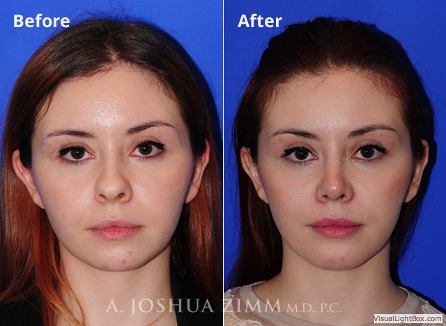 Rhinoplasty2016172 1