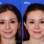 Rhinoplasty2016173 1