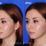 Rhinoplasty2016174 1