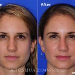 Rhinoplasty2016175