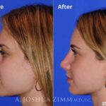 Rhinoplasty2016176