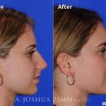 Rhinoplasty2016177