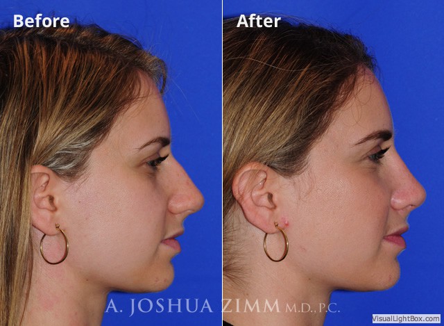 Rhinoplasty2016177