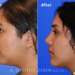 Rhinoplasty201618