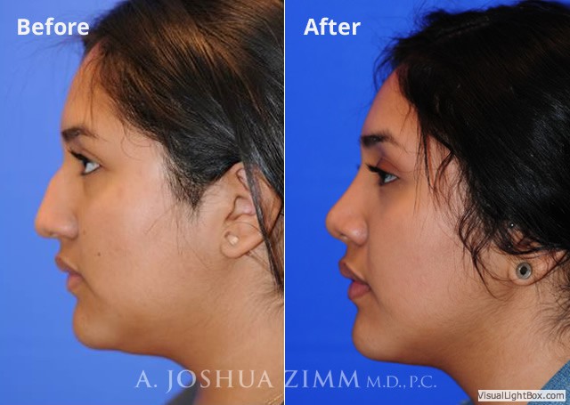 Rhinoplasty201618