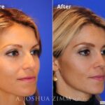 Rhinoplasty201620