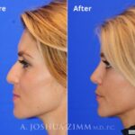 Rhinoplasty201621