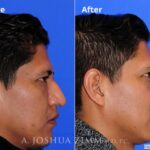 Rhinoplasty201624