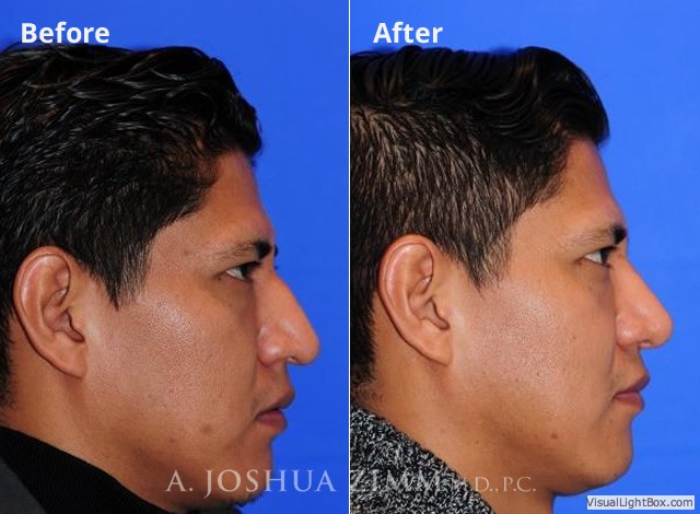 Rhinoplasty201624