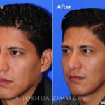 Rhinoplasty201625