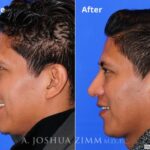 Rhinoplasty201626