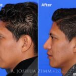 Rhinoplasty201627