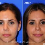 Rhinoplasty201628