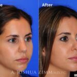 Rhinoplasty201631