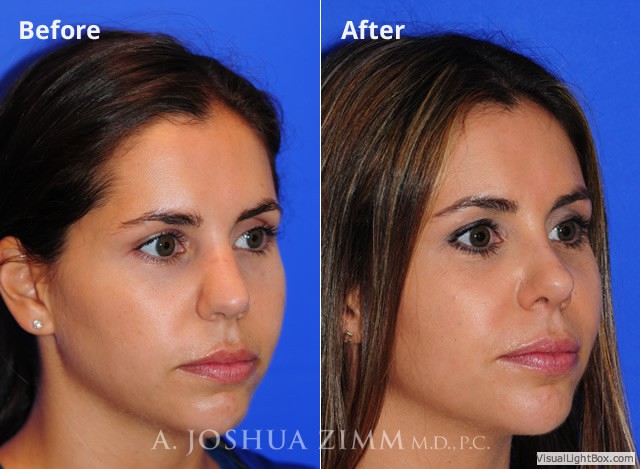 Rhinoplasty201631