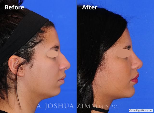 Rhinoplasty201635