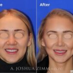 Rhinoplasty201637