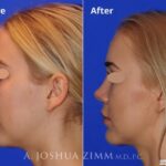 Rhinoplasty201639