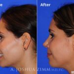 Rhinoplasty201644