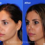 Rhinoplasty201645