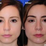 Rhinoplasty201658