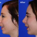 Rhinoplasty201659