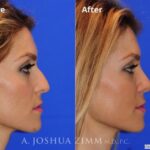 Rhinoplasty201661