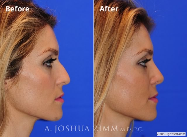 Rhinoplasty201661
