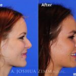 Rhinoplasty201666