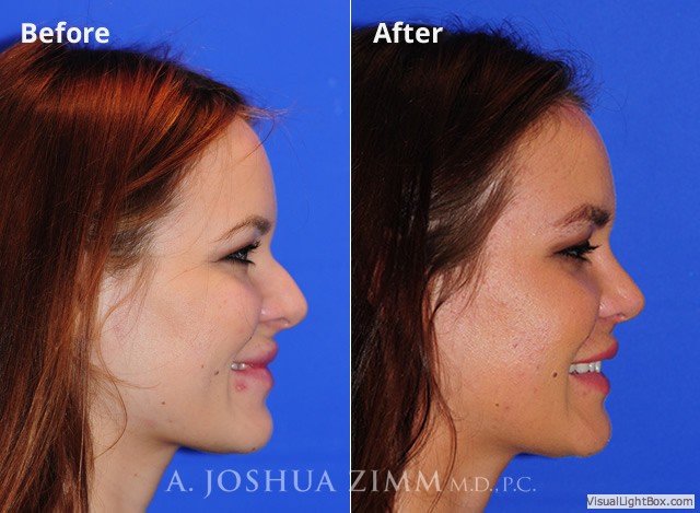 Rhinoplasty201666
