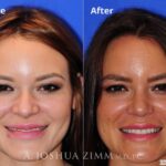 Rhinoplasty201667