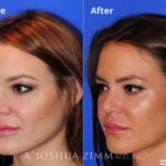 Rhinoplasty201668