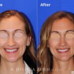 Rhinoplasty201670