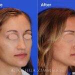 Rhinoplasty201671