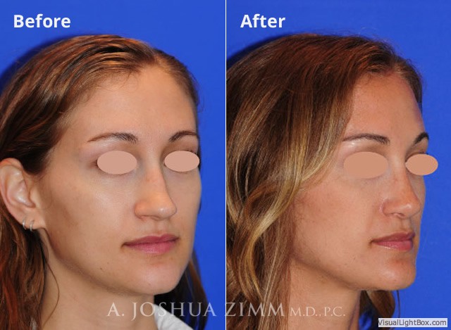 Rhinoplasty201671