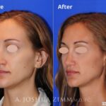 Rhinoplasty201672