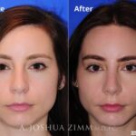 Rhinoplasty201675 1