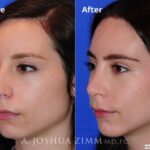 Rhinoplasty201676 1