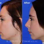 Rhinoplasty201677 1